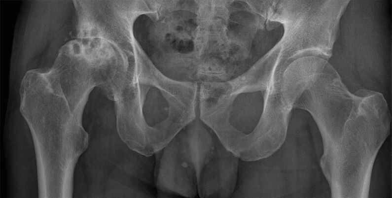 Arthrose des Hüftgelenks im Stadium 3 im Röntgenbild