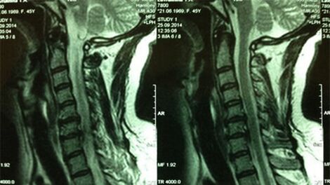MRT der Abteilung für Cervical