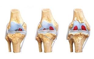 Stadien der Arthrose des Kniegelenks