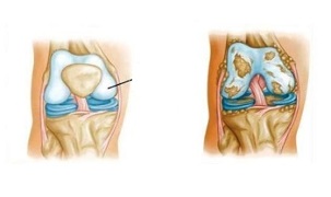 pathologische Veränderungen bei Knie-Arthrose