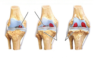 Stadien der Knie-Arthrose