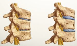 Wie sieht Osteochondrose aus 