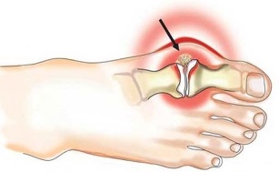 Schwellung des Gelenks zwischen Daumen und Fuß bei Arthritis. 